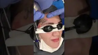 Proses Hapus Tatto Menggunakan Laser