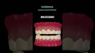 #BRUXISMO El enemigo silencioso de los dientes #ovidental