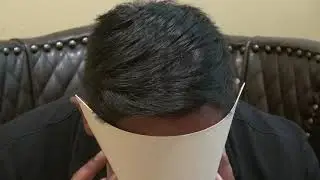 Bald Hair Loss Treatment Manual FUE Receding Hairline Hair Transplant Surgery Corners Dr. Diep