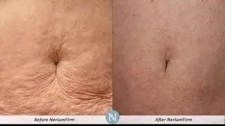 NeriumFirm: Tighten and Tone Loose Skin