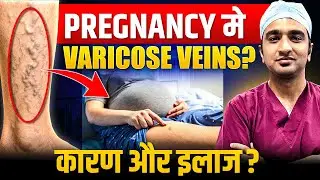 Varicose Veins Treatment in Pregnancy | Leg Pain and Swelling | Treatment Without Surgery in Hindi