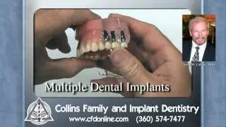Partial dentures vs dental implants, by Collins Family and Implant Dentistry, Vancouver, WA