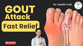 Gout Attack Fast Relief  & Long Term Prevention (Doctor Explains)