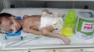 Part Seven | Premature Baby NG Tube Feeding Paper Feeding Method in NICU, Slow Progress Strong 🍼🍼