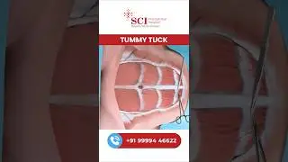 Tummy Tuck Surgery Explained 😱 | Flat Stomach Ka Secret? #tummytuck