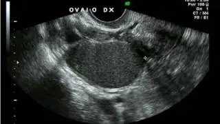 Cisti endometriosica