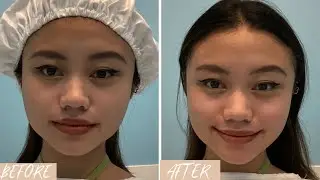 BEST SLIMMING TREATMENT FOR CHUBBY CHEEKS, ARMS, THIGHS, ABDOMEN| DR. WHITE AND GLOW SM SANTA ROSA