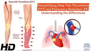 Vein Vigilance: A Deep Dive into DVT and Pulmonary Embolism