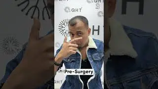 Hair Transplant Surgery Experience | Latest Fue Technique #shorts #viral #hair transplant
