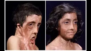 Evaluation Of Burn Surgery By Plastic Surgeon In Lahore