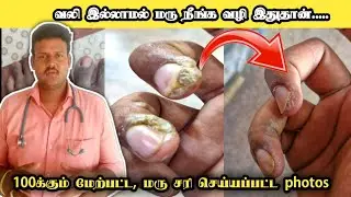 warts remove tamil | warts treatment tamil | warts | maru poga ointment in tamil | மரு குணமாக
