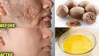 Nutmeg (Jaiphal) Face Mask to get rid of Acne Scars, Dark Spots & Hyperpigmentation Naturally
