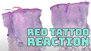 Tattoo reaction (skin allergy from red tattoo ink) Granulomatous dermatitis pathology histology