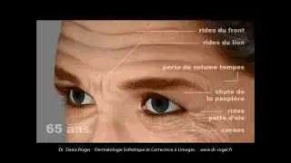 Injection de Botox à Limoges. Traitement des rides du front, patte d'oie, du lion)