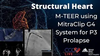 M-TEER using MitraClip G4 System for P3 Prolapse
