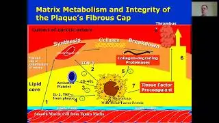 Lesson 2 5   Fibrous Cap and Thrombus Formation