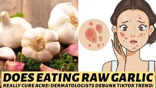 Does Eating Raw Garlic Really Cure Acne? Dermatologists Debunk TikTok Trend!