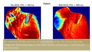 Study Shows Hydroxychloroquine&rsquo;s Harmful Effects on Heart Rhythm