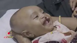 বিদেশি চিকিৎসকদের সহযোগিতায় প্রায় ১শো জন ঠোঁট ও তালুকাটা শিশু পেলো নতুন জীবন।