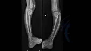 Infected Non-Union Tibia in Children - Dr. Ruta Kulkarni
