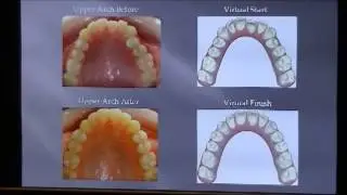 NYC Orthodontist Fixes Crowding in Teens with Teen Invisalign