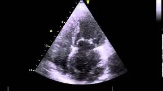 Echo6 Mitralstenose