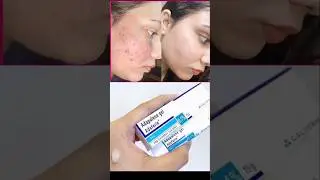 Adapalene Gel |Adapalene gel 0.1 |adapalene gelreview |Adaferin gel |Adaferin gel 0.1 reviews