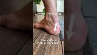 Life with hypermobility and Ehlers Danlos related symptoms #flexibility