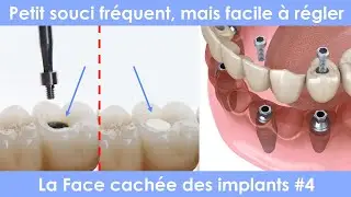 La face cachée des implants dentaires - #4 - Perdre un plombage composite qui cache le système vissé