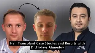 Hair Transplant Case Studies and Results with Dr.Firdavs Ahmedov