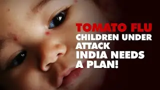 All you need to know about spreading 'TOMATO FLU' in India | SYMPTOMS | TREATMENT