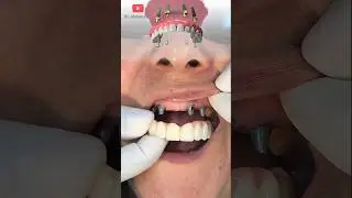 Невероятное преображение! ❤ зубные имплантаты