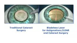 LenSx technology - LASER cataract Surgery