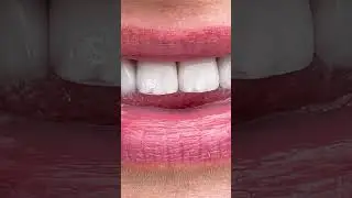Types of False Tooth | Veneers