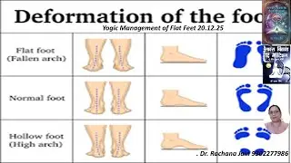 Yogic Management of Flat Feet , What is Deformation of Feet by Dr Rachana Jain 20.12.25