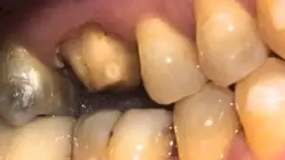 Biocopy with Invisalign Using Omnicam