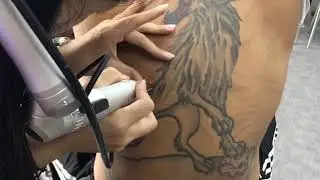 Pico laser tattoo removal Sydney Xara Skin CLinic