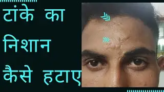 टांके के निशान का इलाज और खर्चा | Tanke ke Nishan Treatment and expense | Dr Goyal | Kayakalp