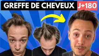 Greffe de cheveux : Il retrouve sa chevelure en seulement 6 mois 😱