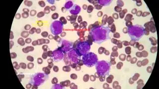 Acute Monoblastic Leukemia,M5b