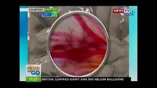 NTG: Brain Aneurysm: Ano ba ang sanhi nito?