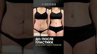 3 НЕДЕЛИ ПОСЛЕ ПЛАСТИКИ ЖИВОТА🤩 #пластическаяоперация #пластическаяхирургия