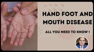 &ldquo;Hand, Foot & Mouth Disease Explained: Symptoms, Causes & Treatment&rdquo;