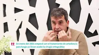 Paciente Dr. Javier Martín - Operada prognatismo mandibular para acabar con la apnea del sueño