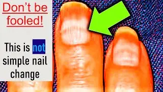 NAIL Color change You should never IGNORE!
