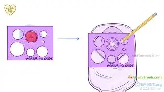 Ostomy Routine Care | Nursing | Osmosis