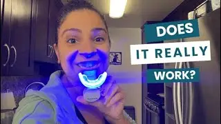 How Well This Puur Smile Teeth Whitening Kit Worked!