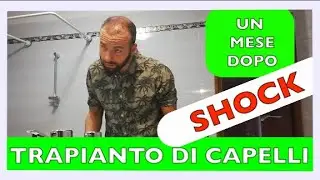 La VERITA' sul post TRAPIANTO di CAPELLI!Dopo un mese sono SHOCKATO!