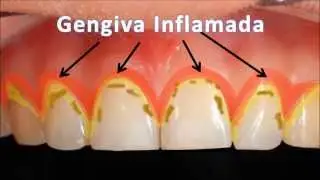 Gengiva