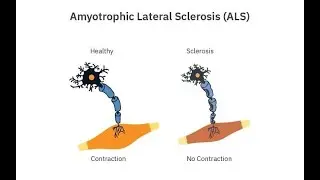 ALS Amyotrophic Lateral Sclerosis or Lou Gehrig&rsquo;s disease, progressive neurodegenerative disorder